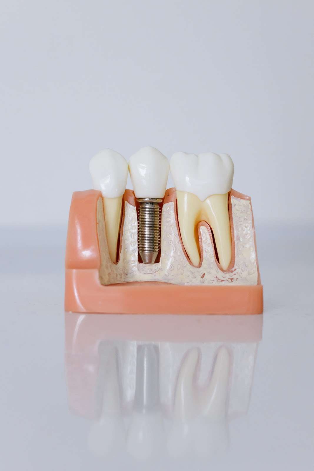 model showing dental implant placed between two teeth